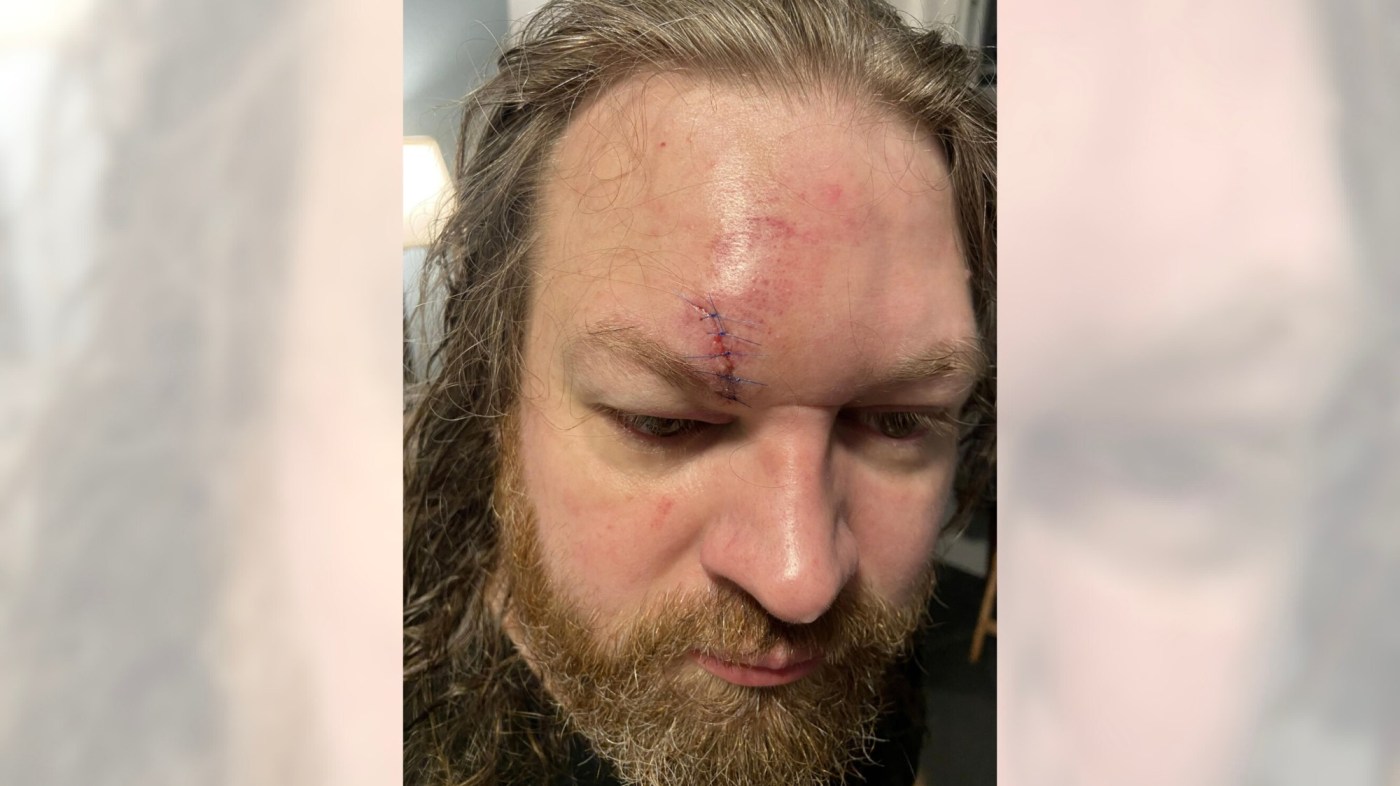 Disneyland fight leaves bloodied dad with stitches after ‘sucker punch’